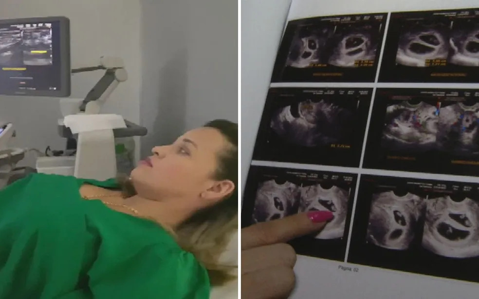 Mãe se surpreende ao descobrir gravidez de quadrigêmeos durante ultrassom