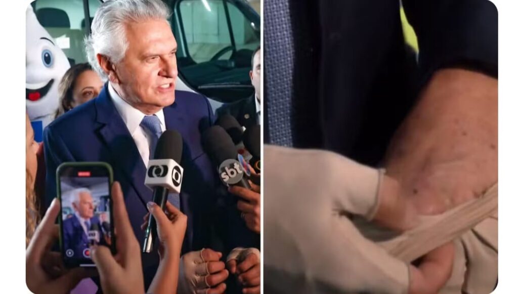 Caiado faz cirurgia para retirar tumores das mãos em tratamento contra câncer de pele